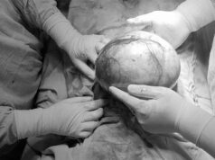 बुरहानपुर में मेडिकल टीम ने किया कमाल, महिला के पेट से निकाला विशाल 8 किलो ट्यूमर