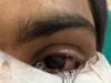 स्किन ग्राफ्टिंग से मरीज के पलक का सफल पुनर्निर्माण