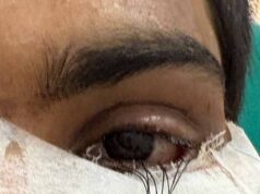 स्किन ग्राफ्टिंग से मरीज के पलक का सफल पुनर्निर्माण