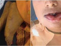 शादी की खुशियां मातम में बदलीं, जहरीली हल्दी लगाने से दुल्हन की दर्दनाक मौत