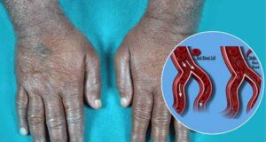 बस्तर में सिकल सेल की जांच तेज, 6 लाख से ज्यादा स्क्रीनिंग में 891 गंभीर मरीज मिले